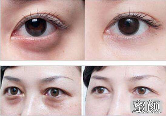 科技揭秘，最新去眼袋最佳方法，重塑眼部美麗新篇章！