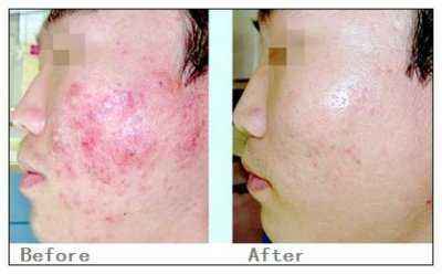 激光祛疤價(jià)格詳解，深度解析與觀點(diǎn)闡述