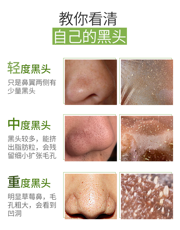 最新去黑頭教程視頻匯總，科技助力美麗重塑，黑頭無憂新篇章