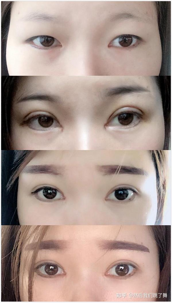 雙眼皮新技術(shù)揭秘，小明的魔法雙眼皮之旅